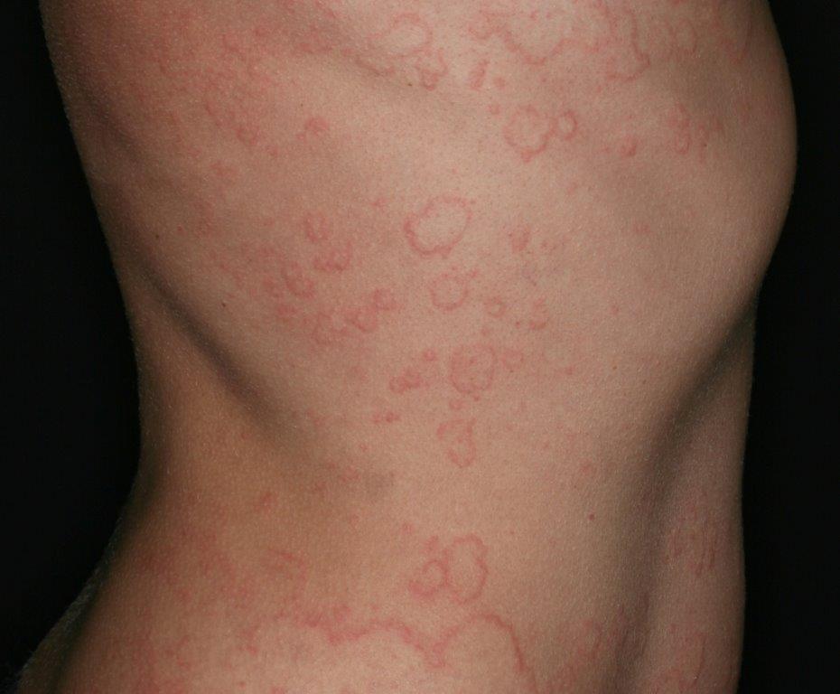 Krooniline spontaannee urtikaaria.
